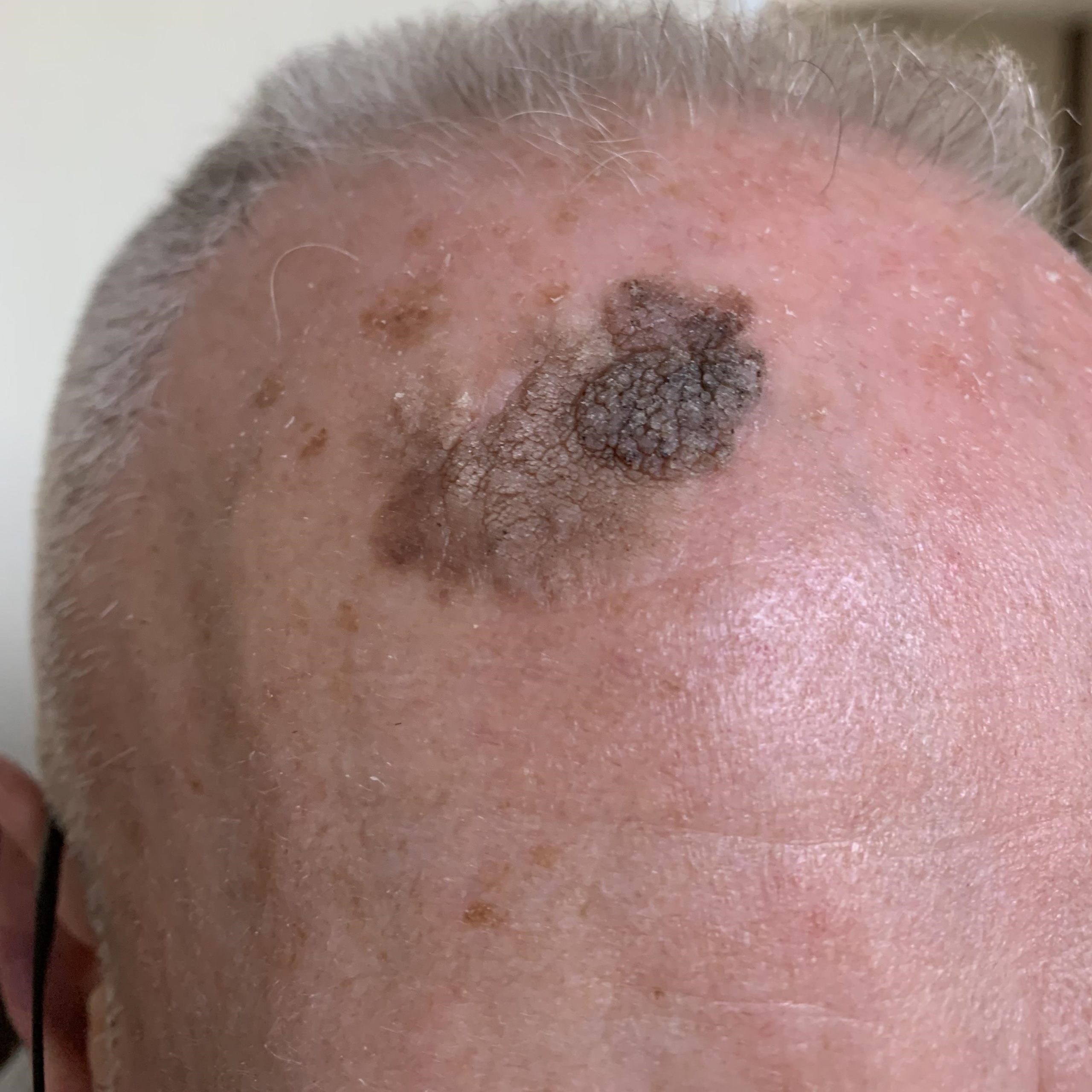 3 weeks post Keratosis removal performed by Dr Javier Montero at our Christchurch Family Medical Practice.