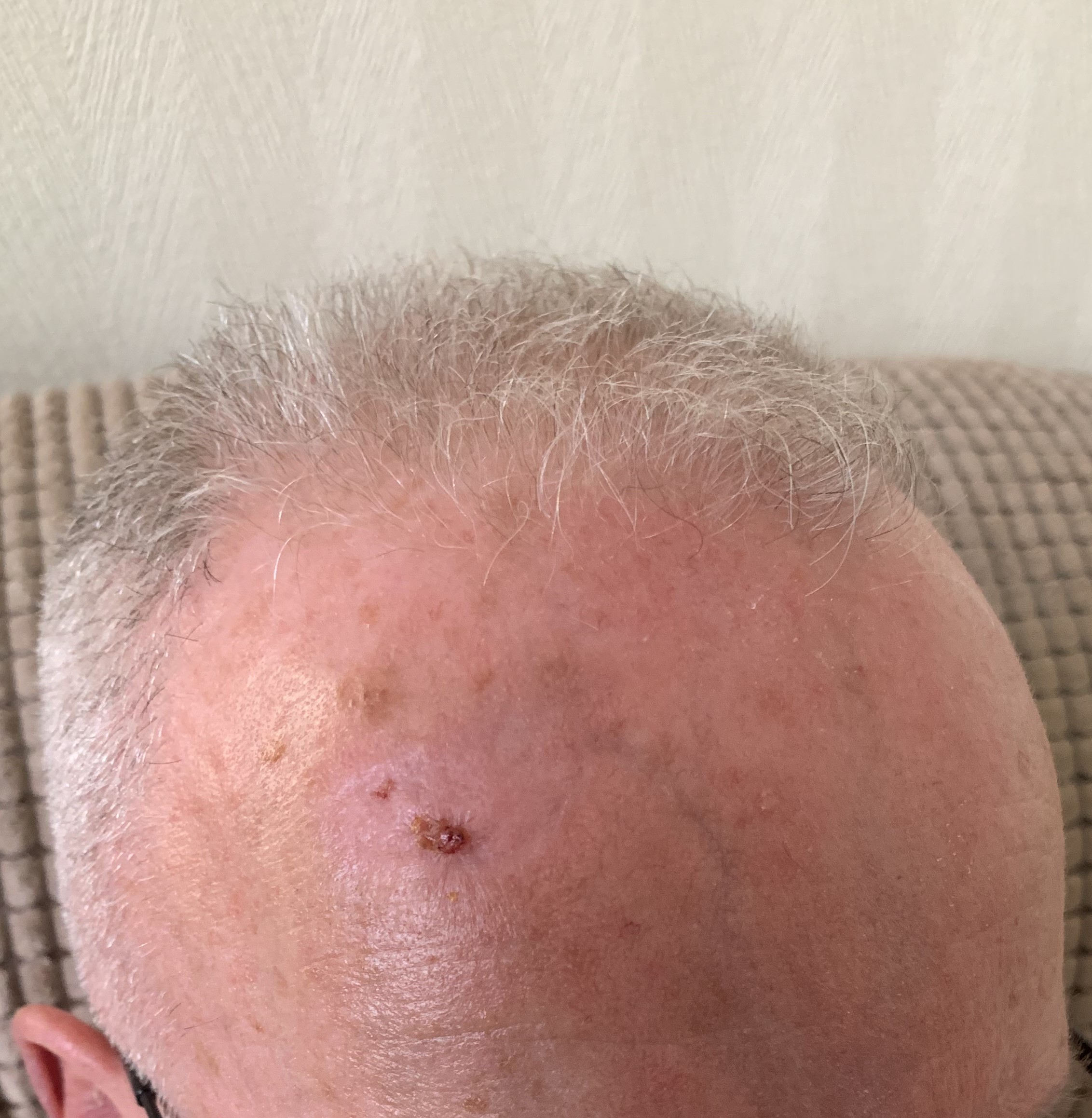 3 weeks post Keratosis removal performed by Dr Javier Montero at our Christchurch Family Medical Practice.